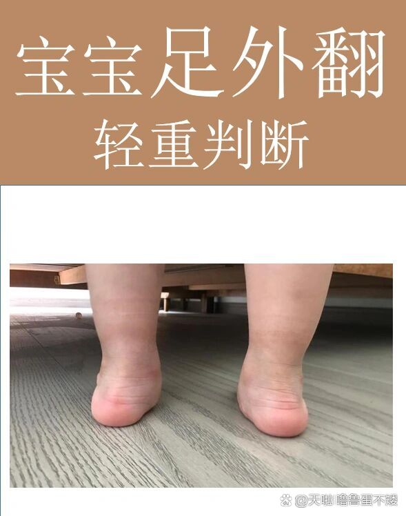 宝宝足外翻轻重判断