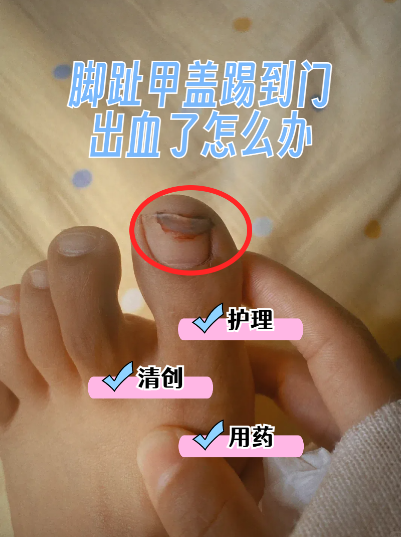 脚趾甲盖踢到门,出血了怎么办