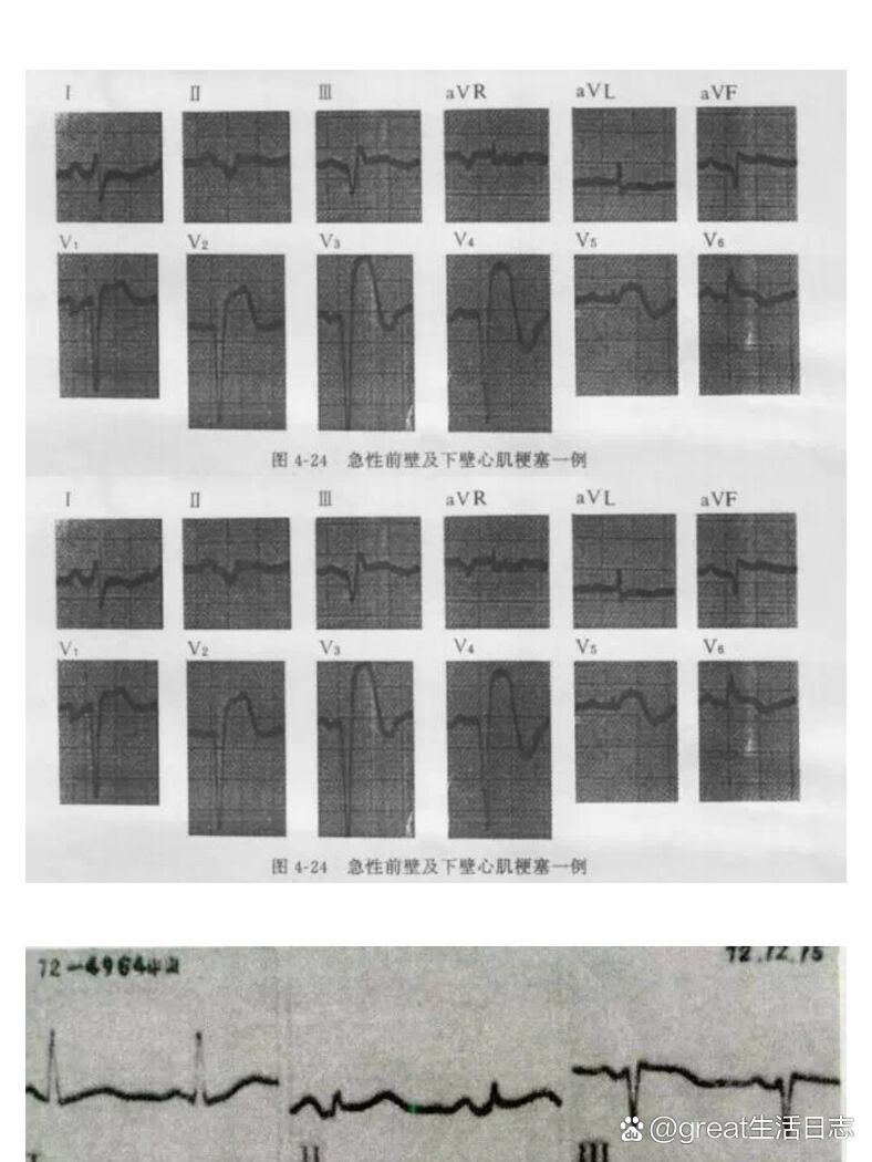 各型冠心病的心电图鉴别诊断