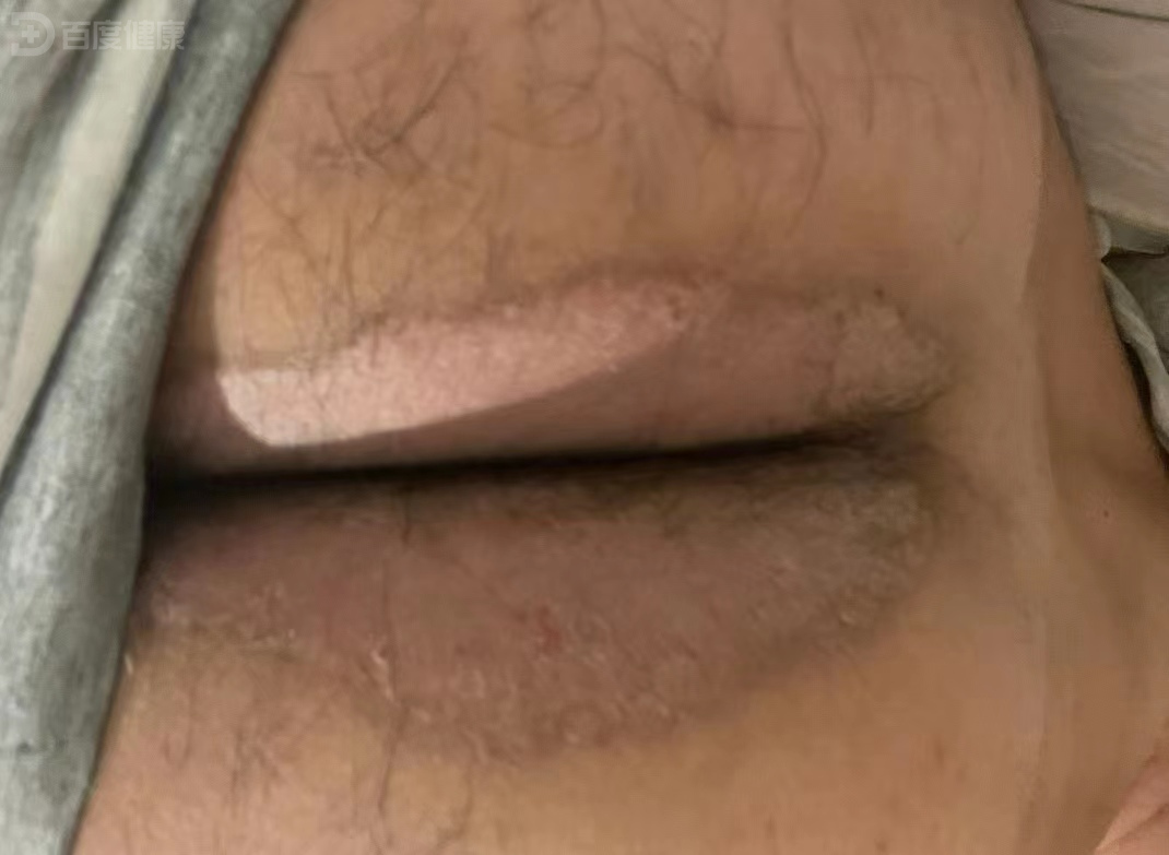 男性臀部出现股癣,几百元即彻底治愈