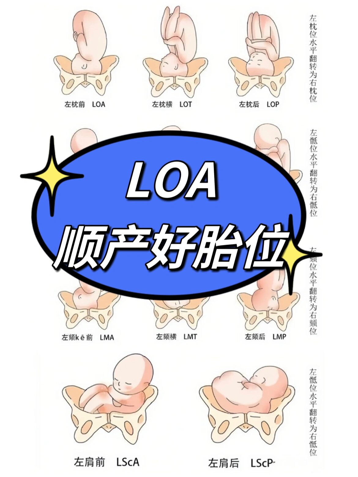 胎位LOA与LOT的区别图片