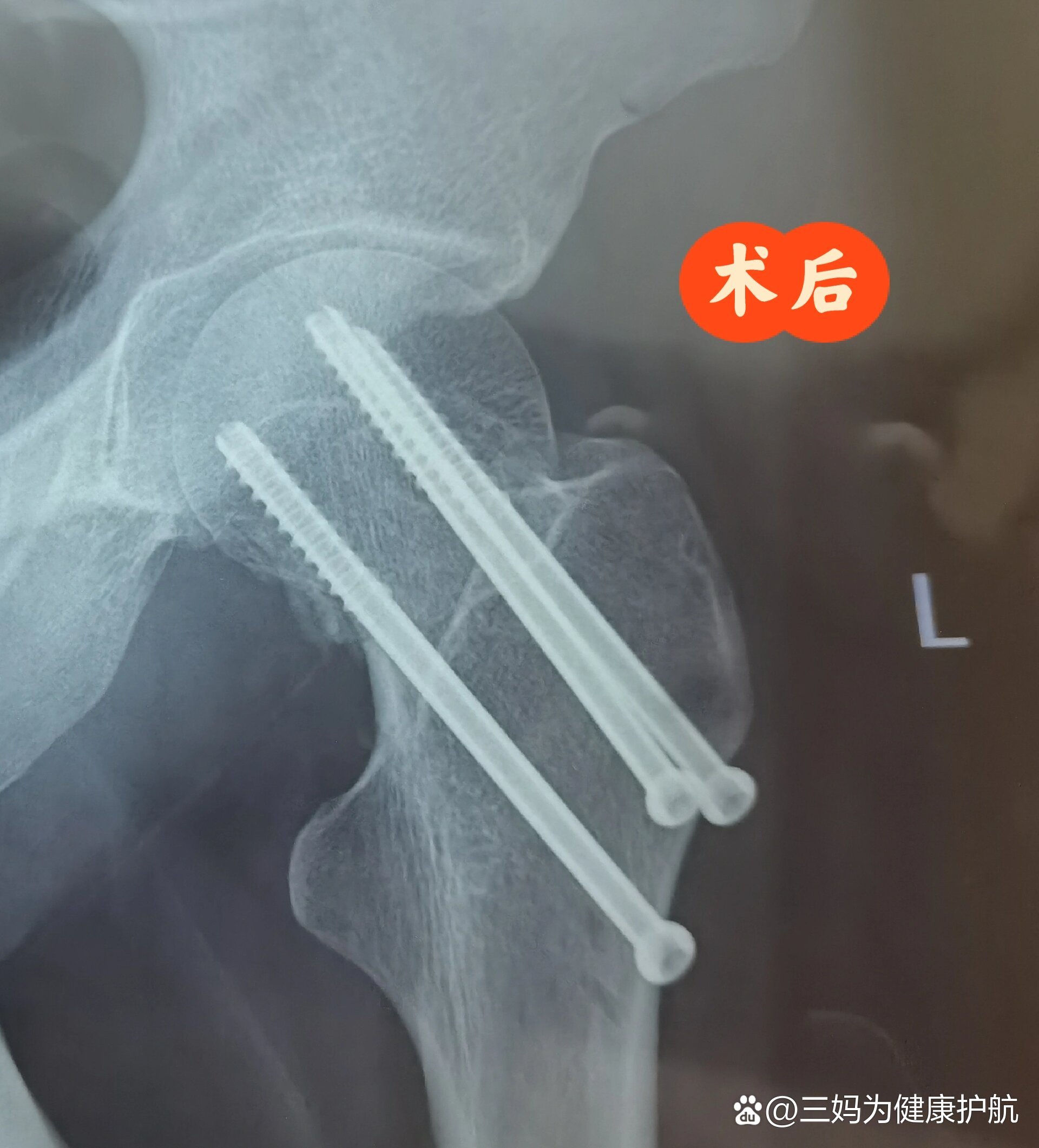股骨颈骨折内固定三颗钉术后50天