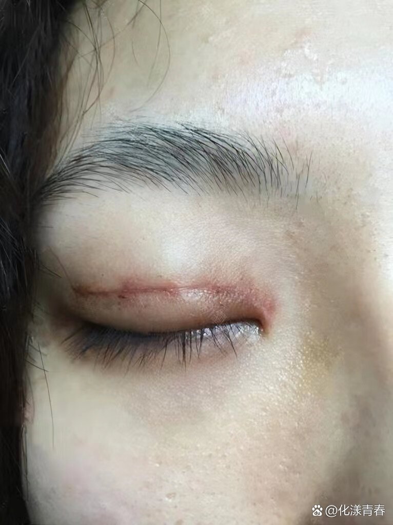 去双眼皮疤痕!