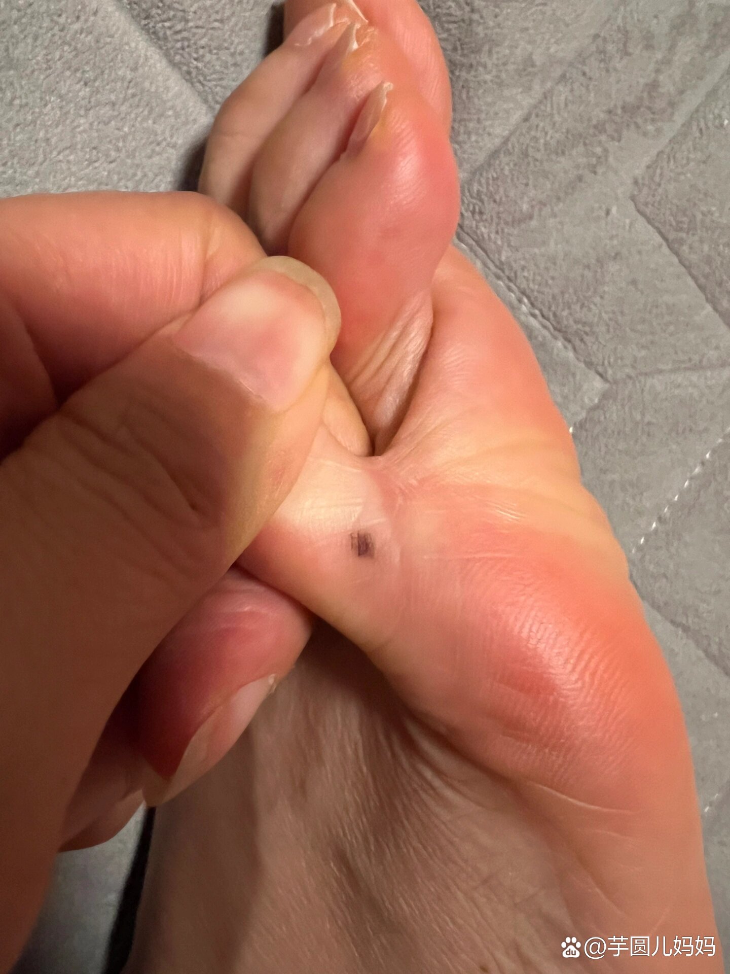 脚低痣,需要切吗