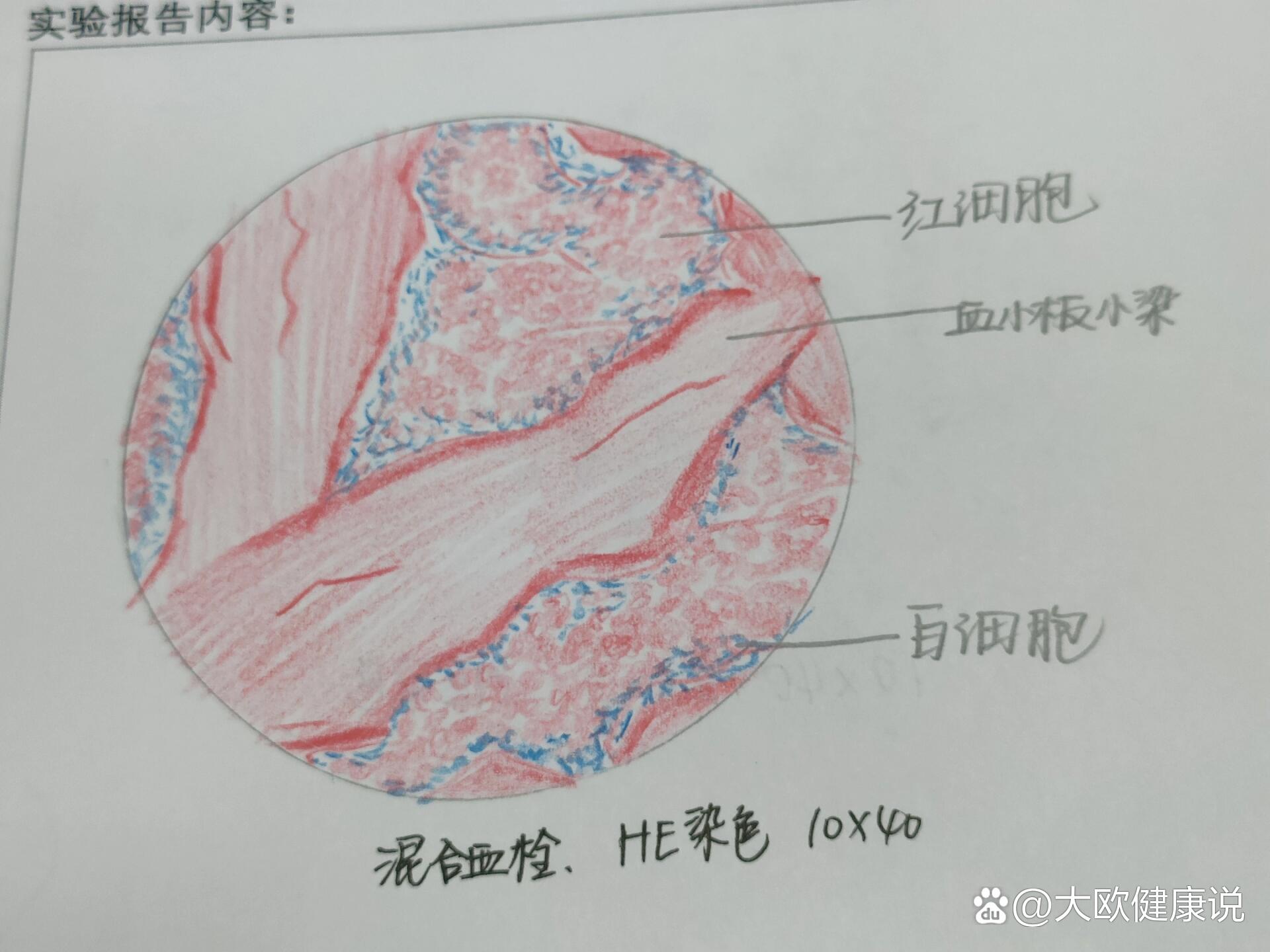 混合血栓红蓝铅笔绘图