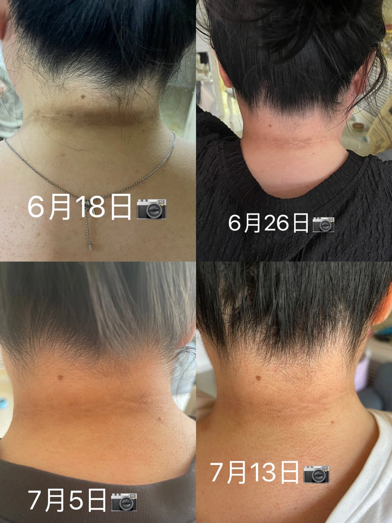 关于黑棘皮的问题希望能帮助跟我一样的姐93