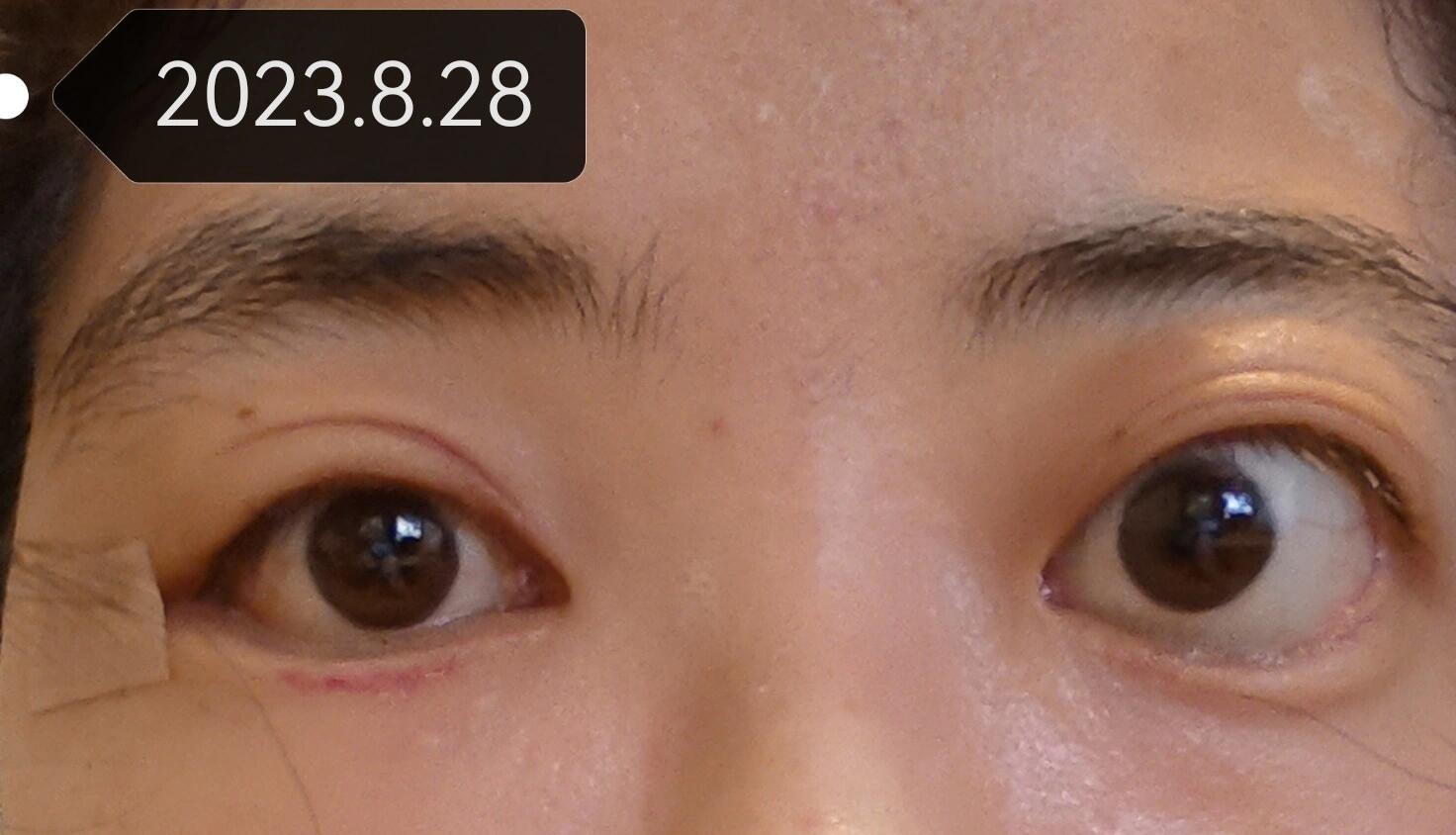 眼眶减压术:你想知道的问题都放这里啦!