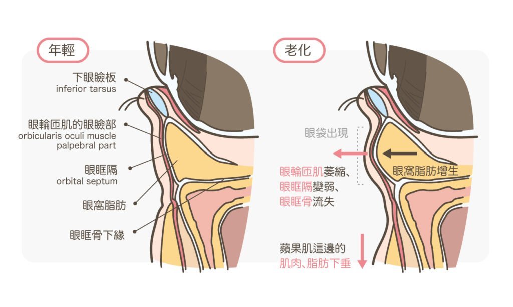 眼袋示意图图片