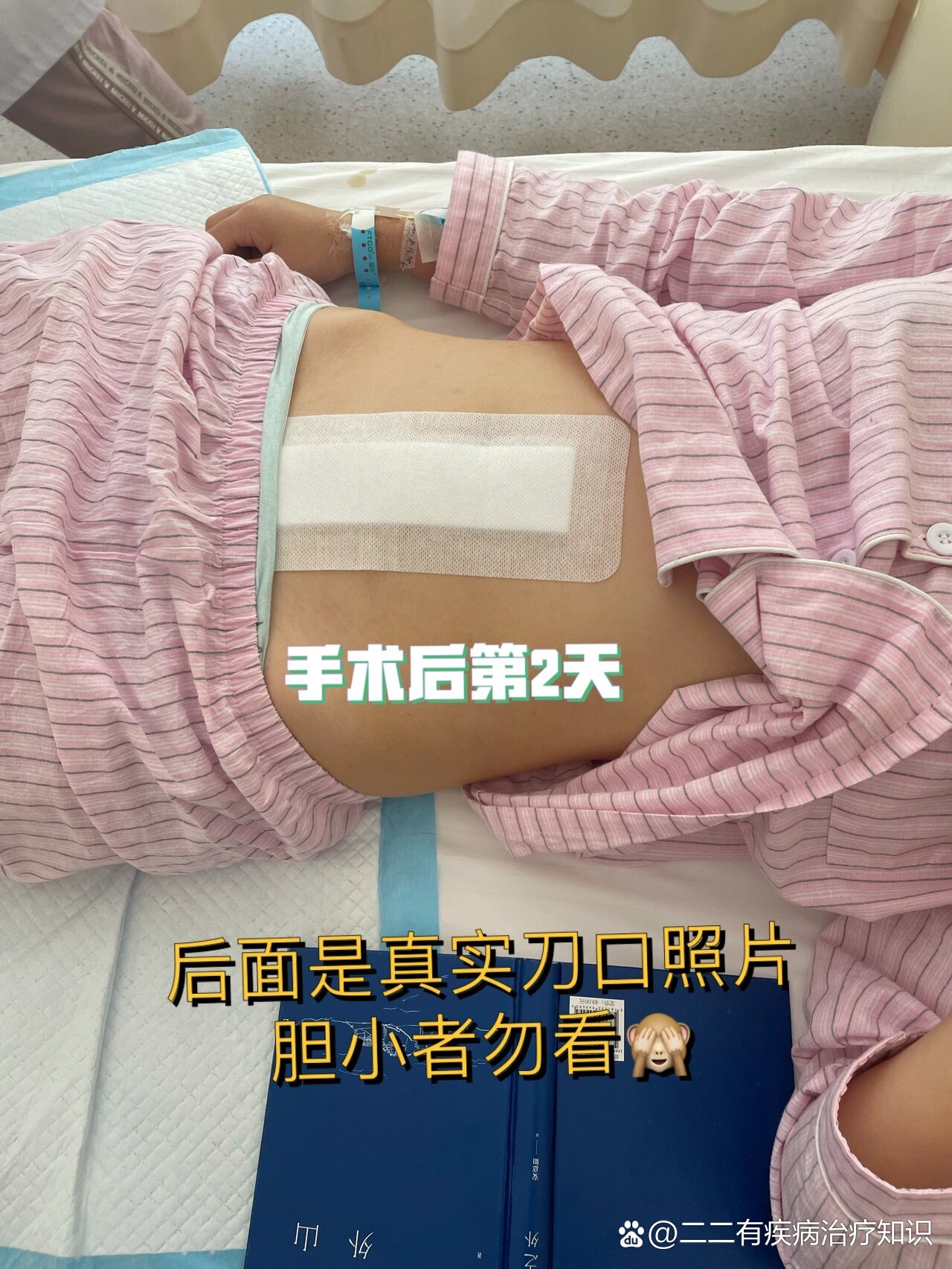 子宫肌瘤开腹手术9厘米刀口恢复