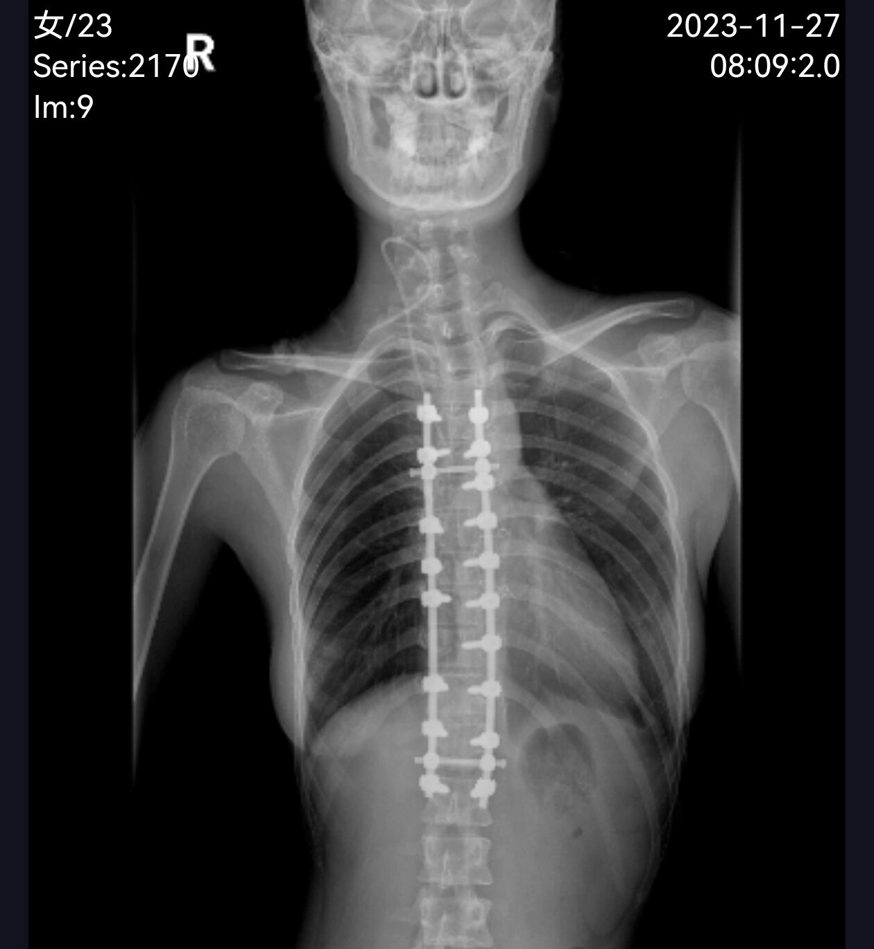 我是一直都知道自己有脊柱侧弯但是由于前几年一直觉得脊柱侧弯手术