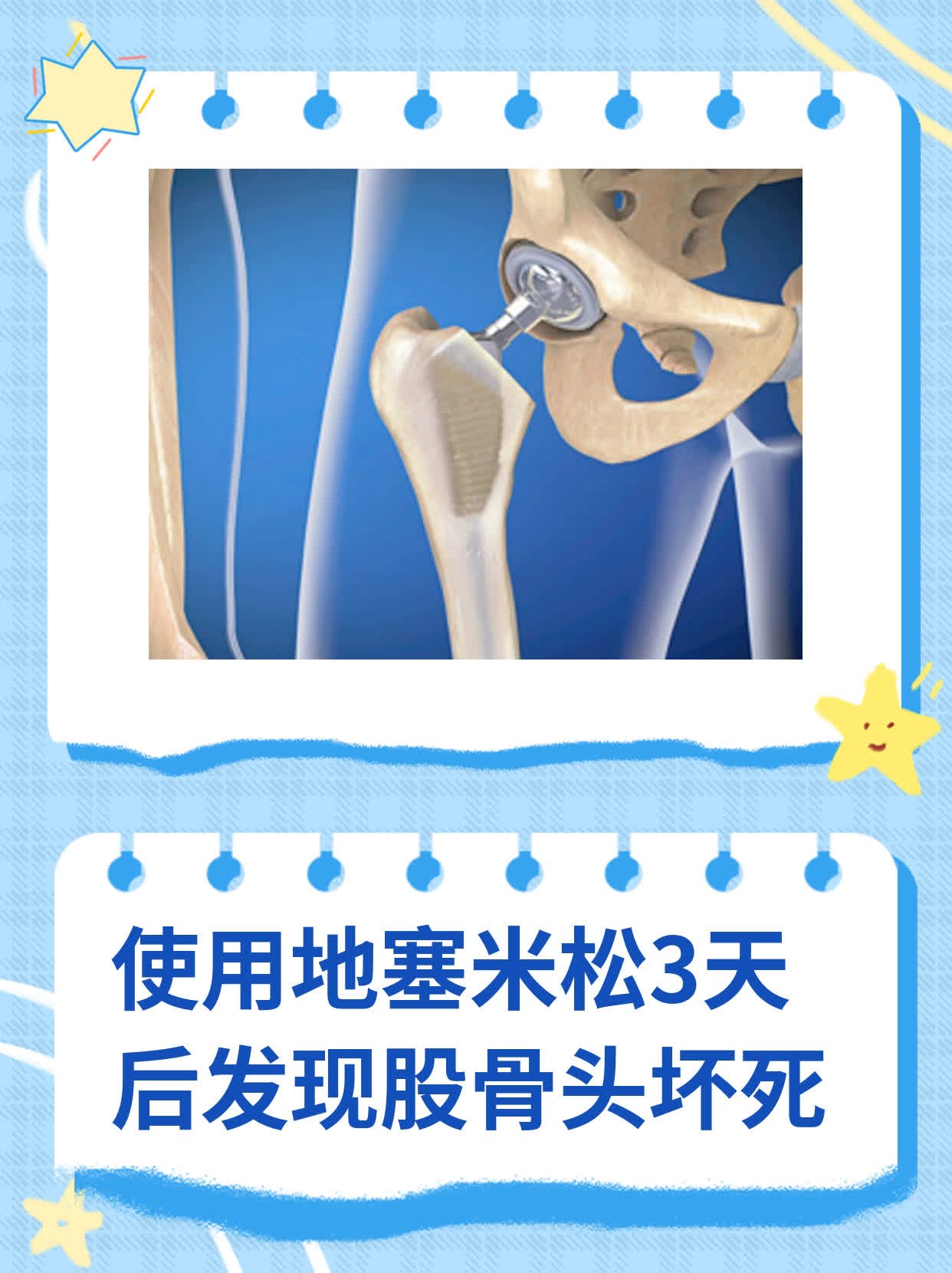 使用地塞米松3天后发现股骨头坏死