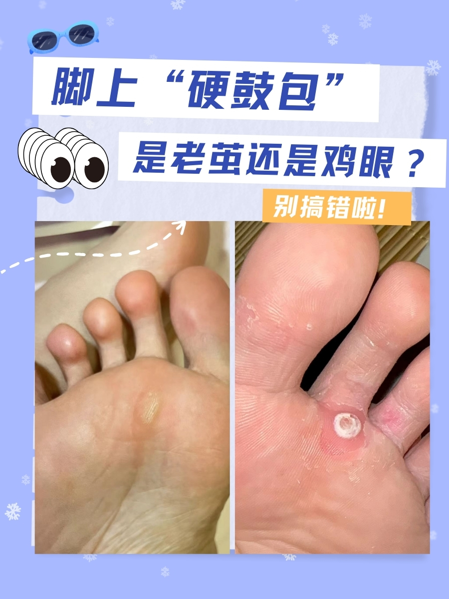 脚上"硬鼓包"是老茧还是鸡眼?别搞错啦!