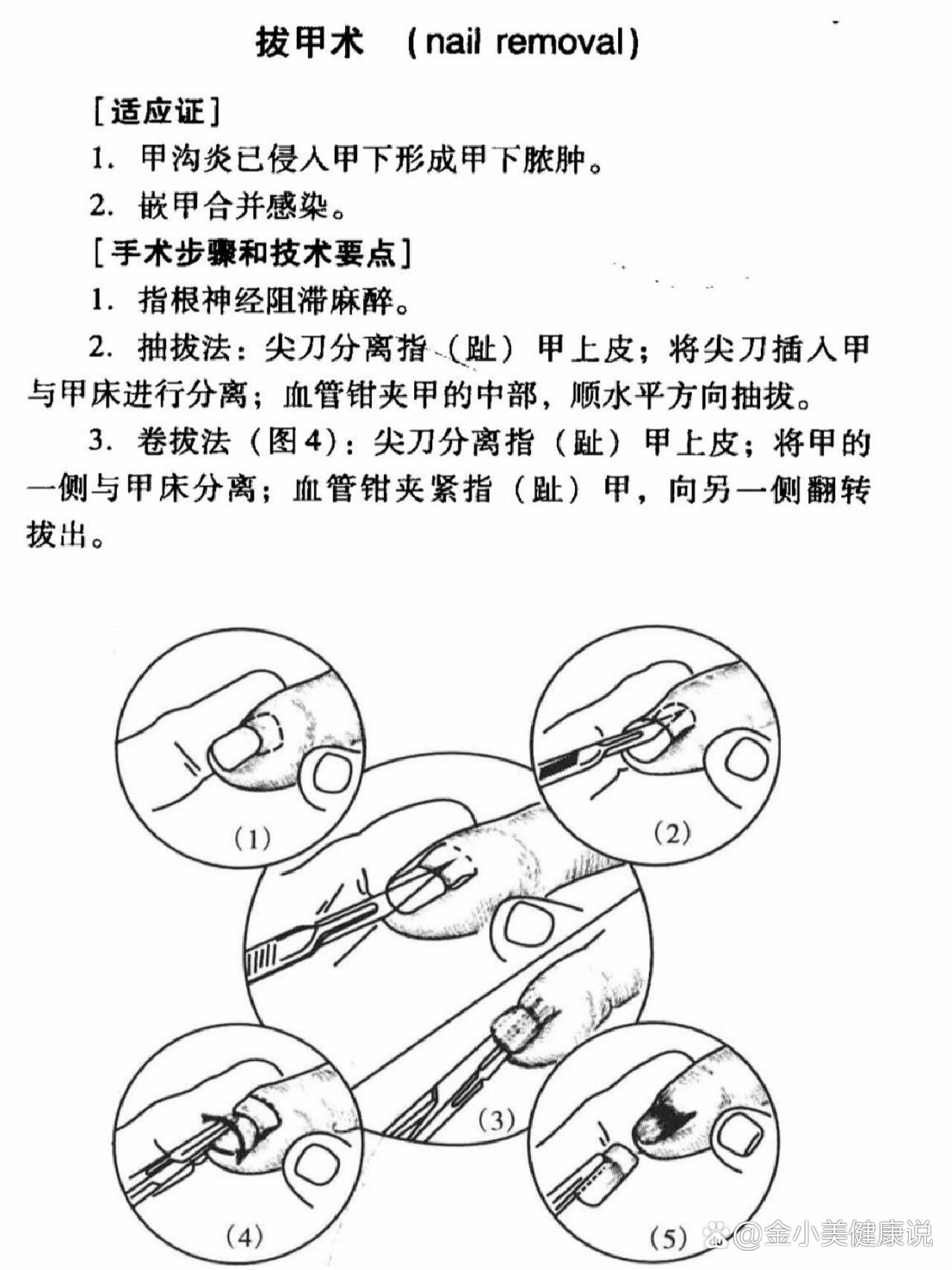 拔指甲的过程图解图片