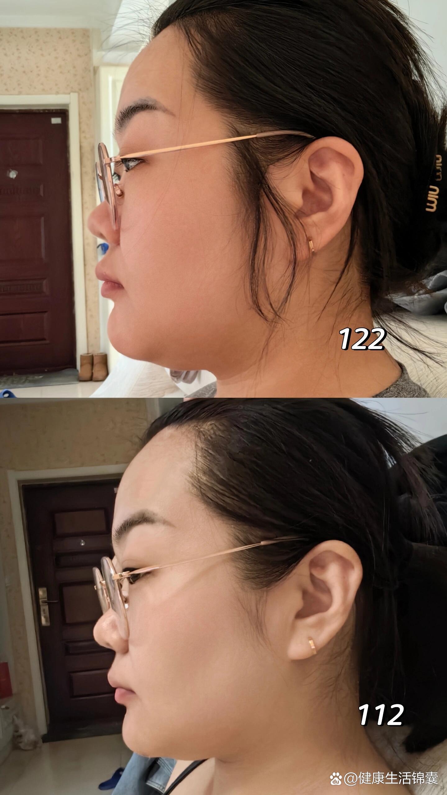  p>瘦10斤面部对比 br>122到112的    正脸 侧脸 对比   减肥真的是一