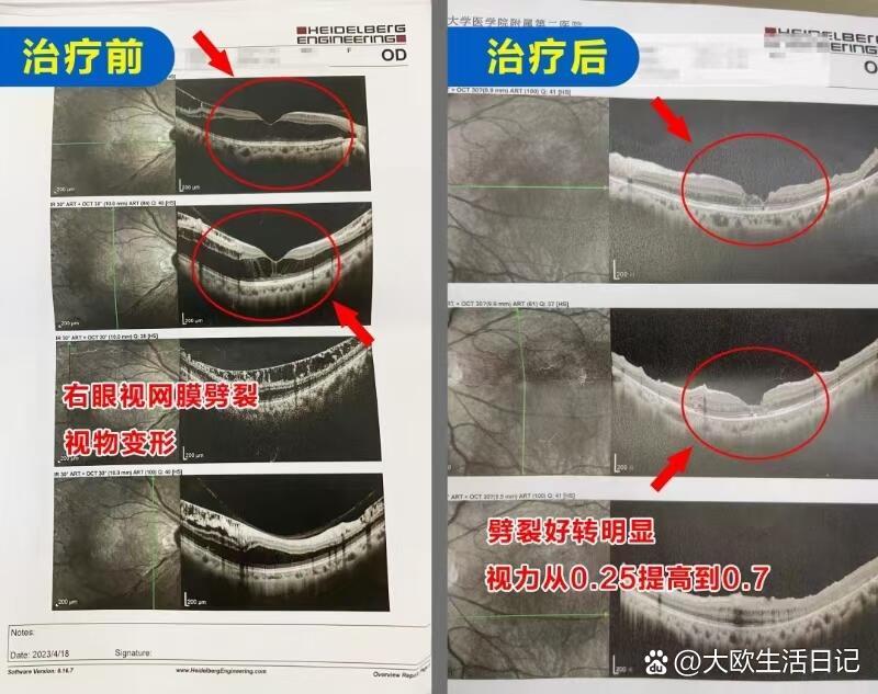 右眼视网膜劈裂