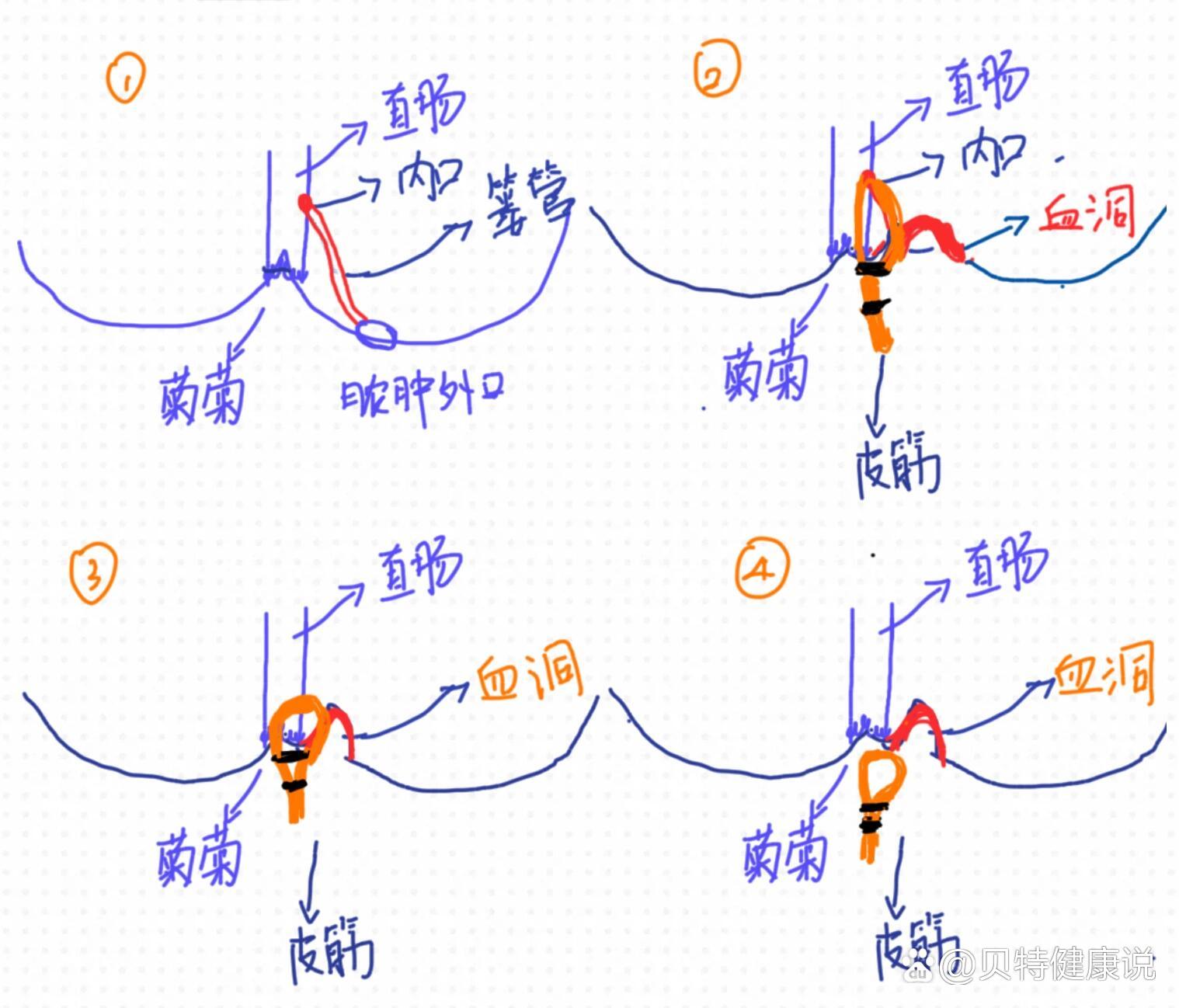 肛周脓肿挂线图图片