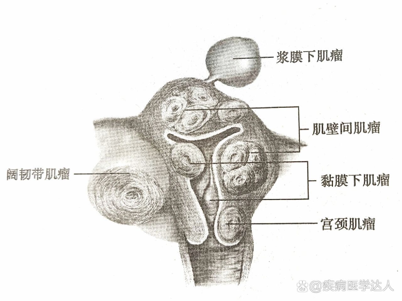 子宫阔韧带位置示意图图片