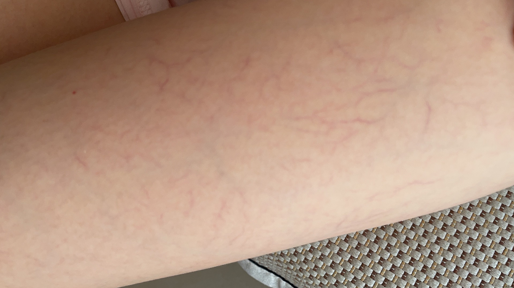  p>大腿上的毛细血管明显 br>这是毛细血管扩张还是别的啥?
