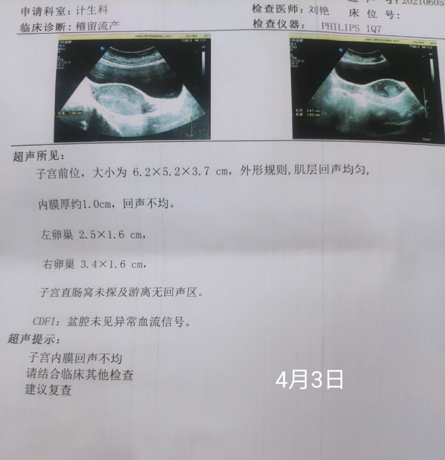 自然流产需要超度吗-自然流产需要休息多久注意些什么