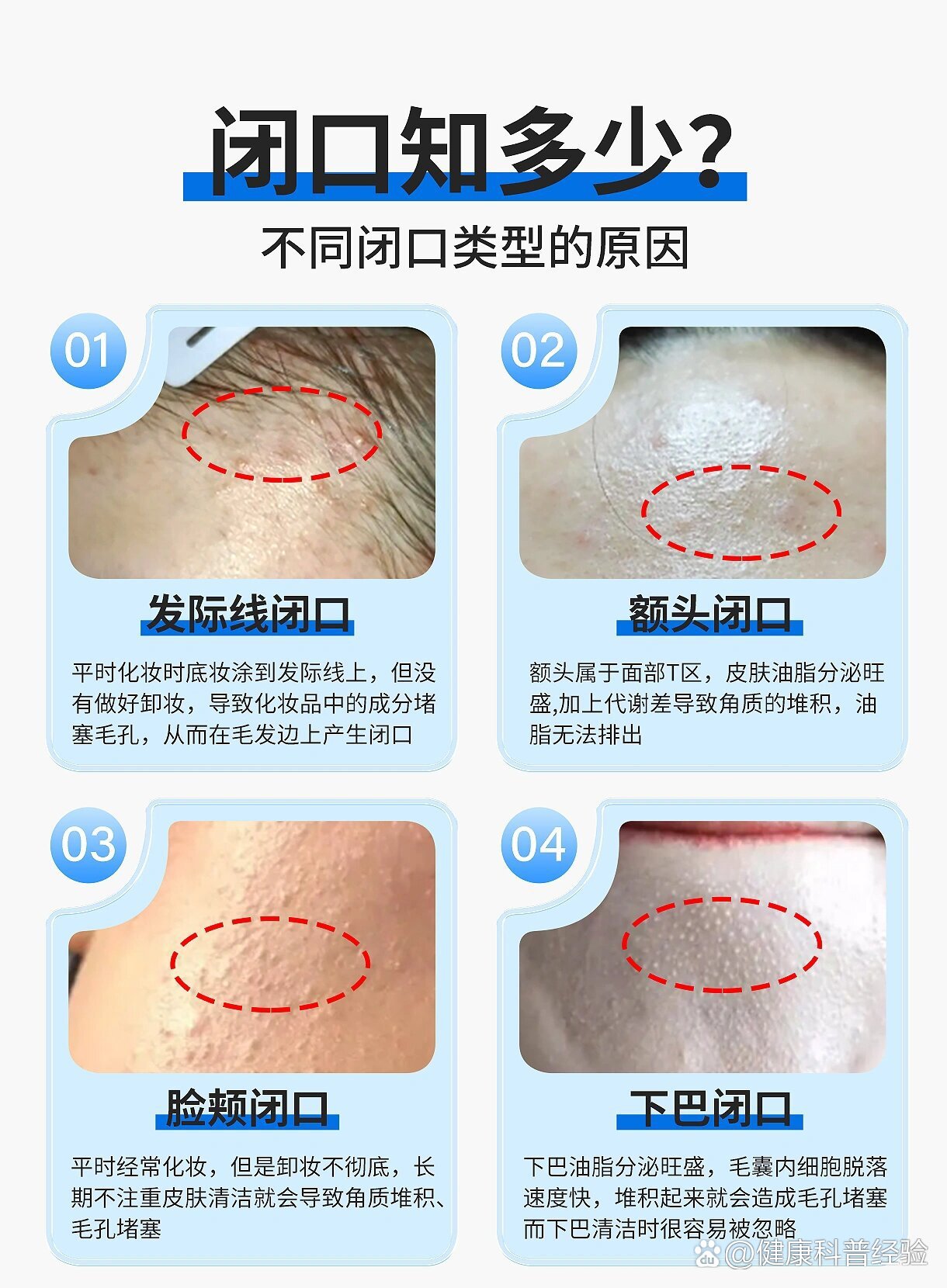 闭口变好的过程图图片