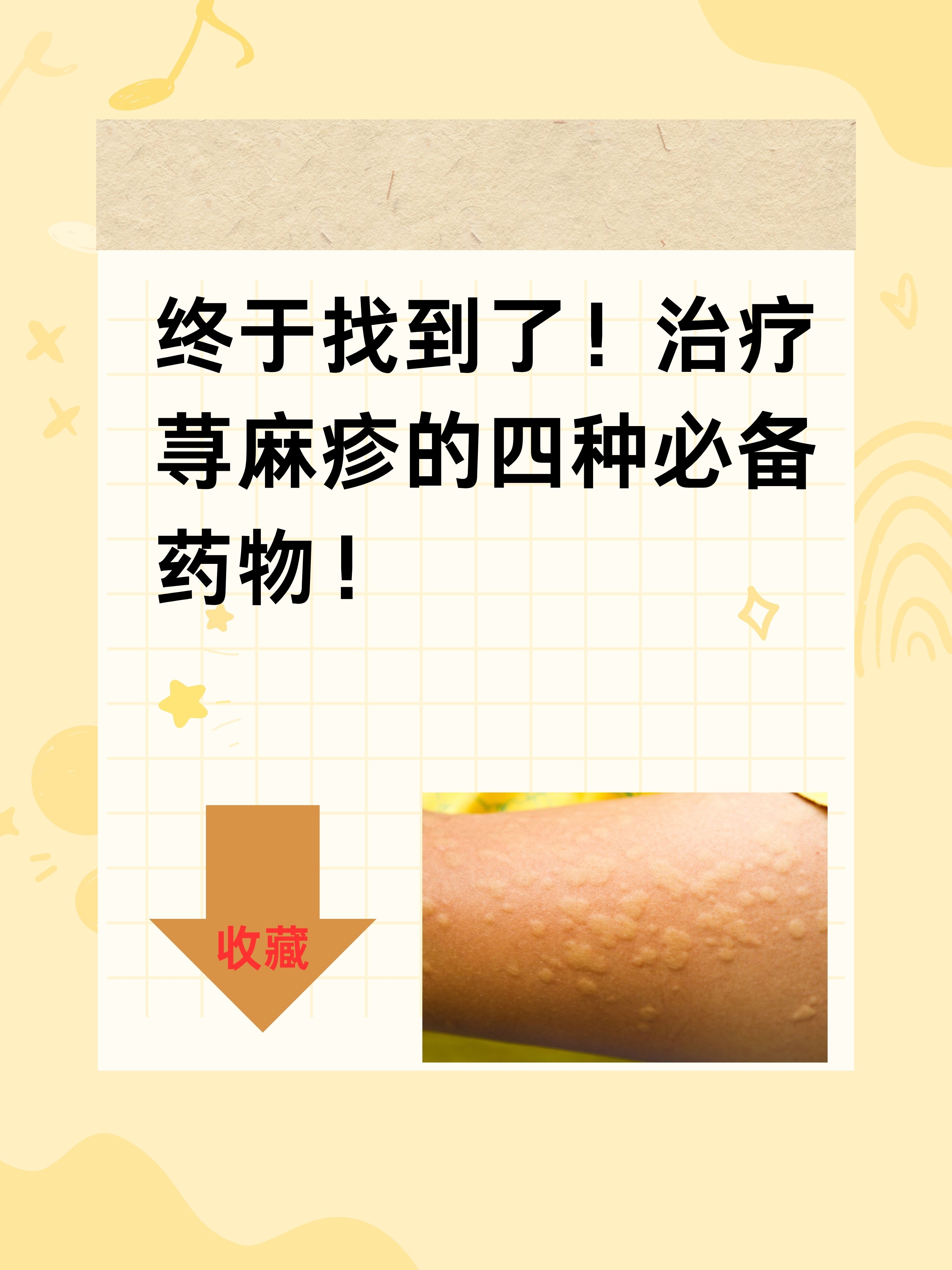 终于找到了!治疗荨麻疹的四种必备药物!