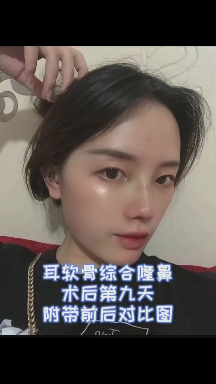 耳软骨隆鼻术后9天效果,前后对比超明显!
