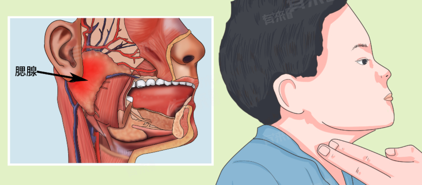 痄腮的症状