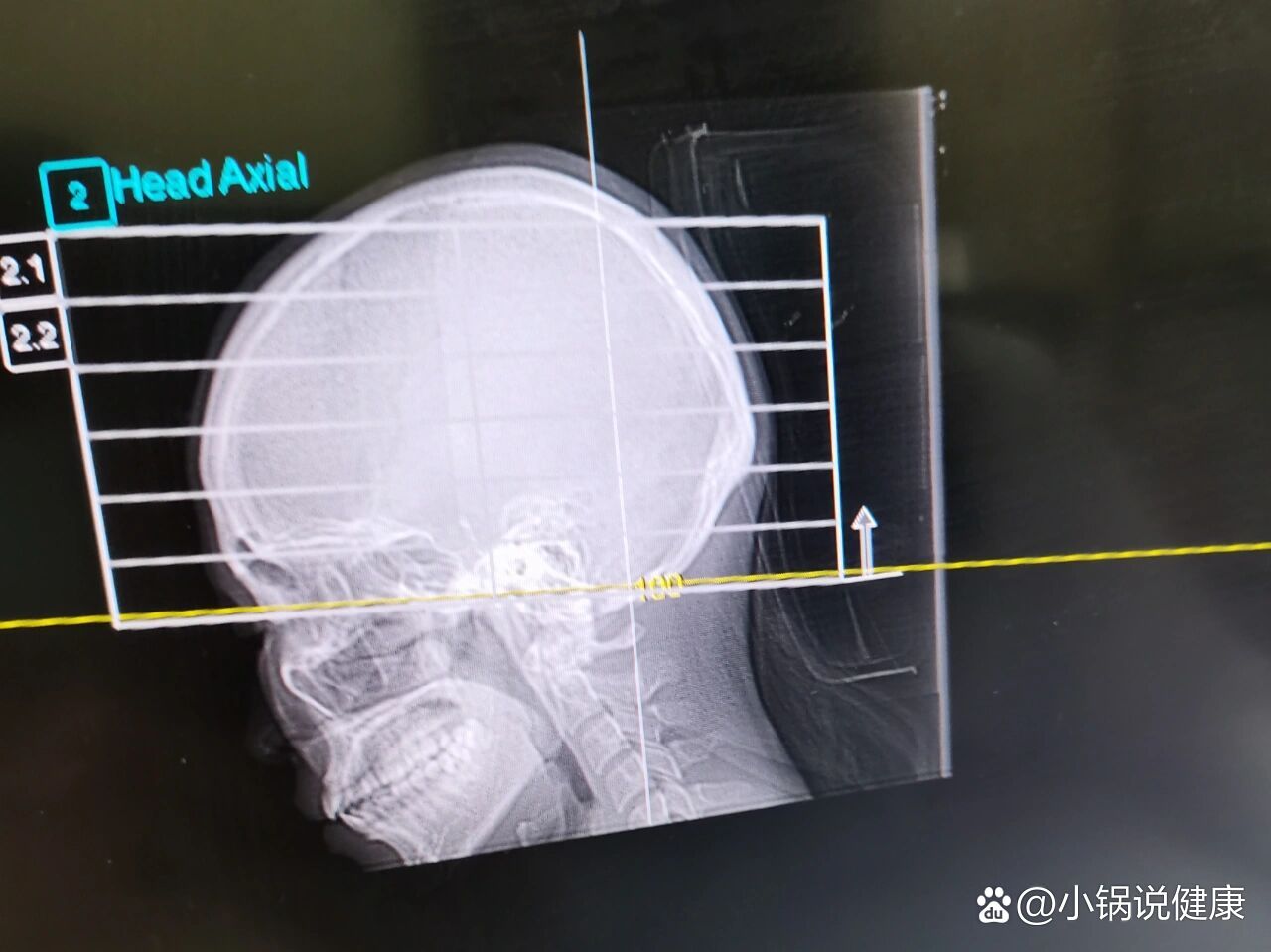 经颅多普勒(tcd)的介绍