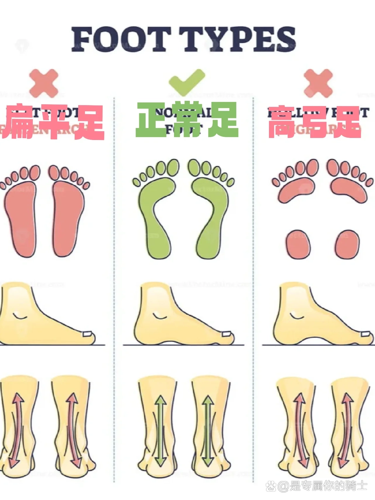 足弓长痣图片