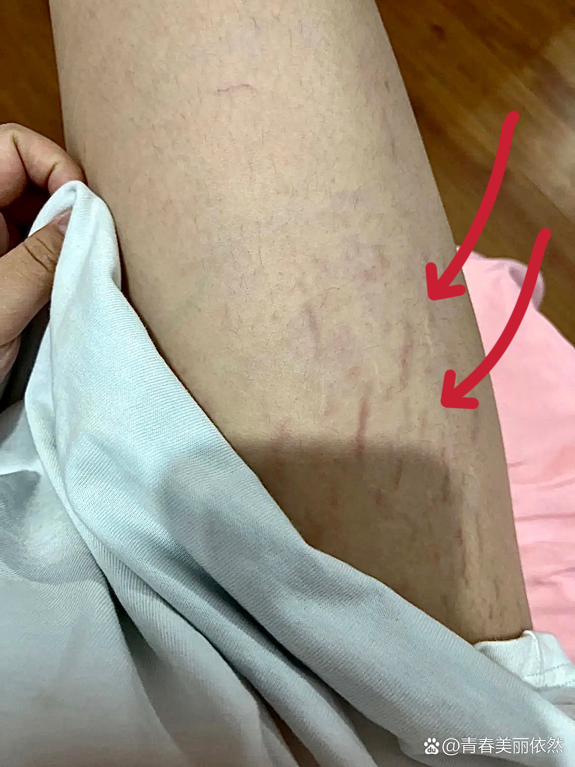 承认了‼️我知道怎么去大腿上的肥胖纹啦