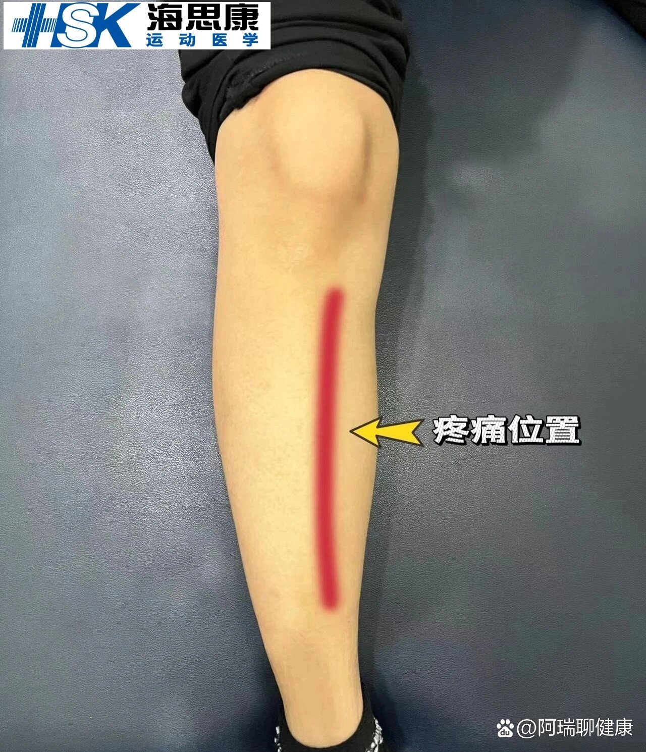 胫骨内侧应力综合征medial tibial stress syndrome主要是由于小腿