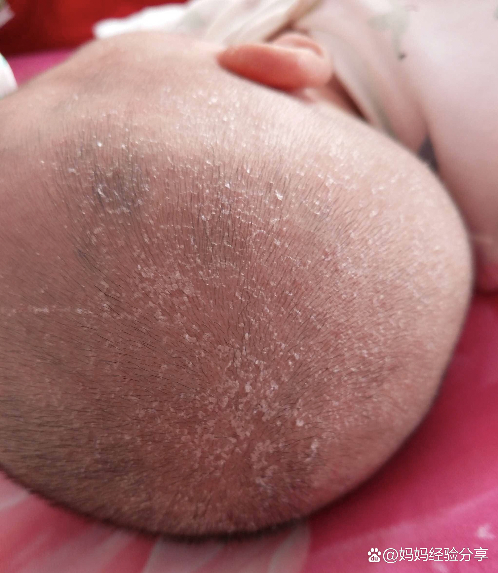 宝宝头上厚厚的结痂如何处理?