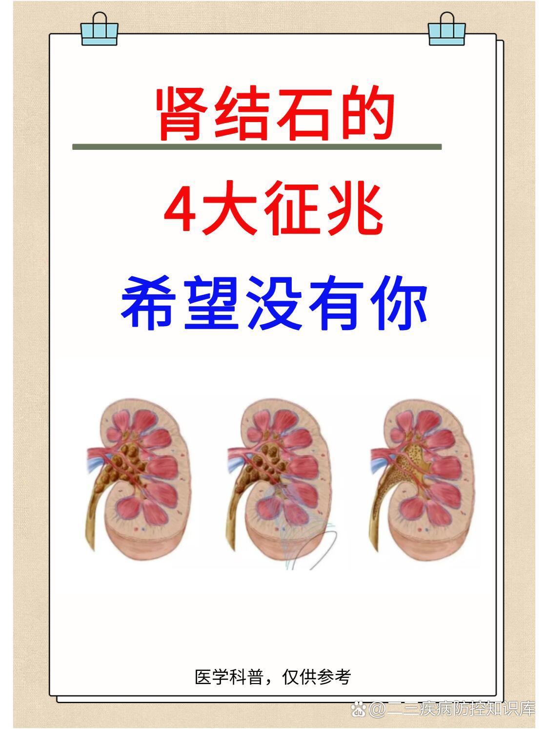 肾结石有哪些症状图片