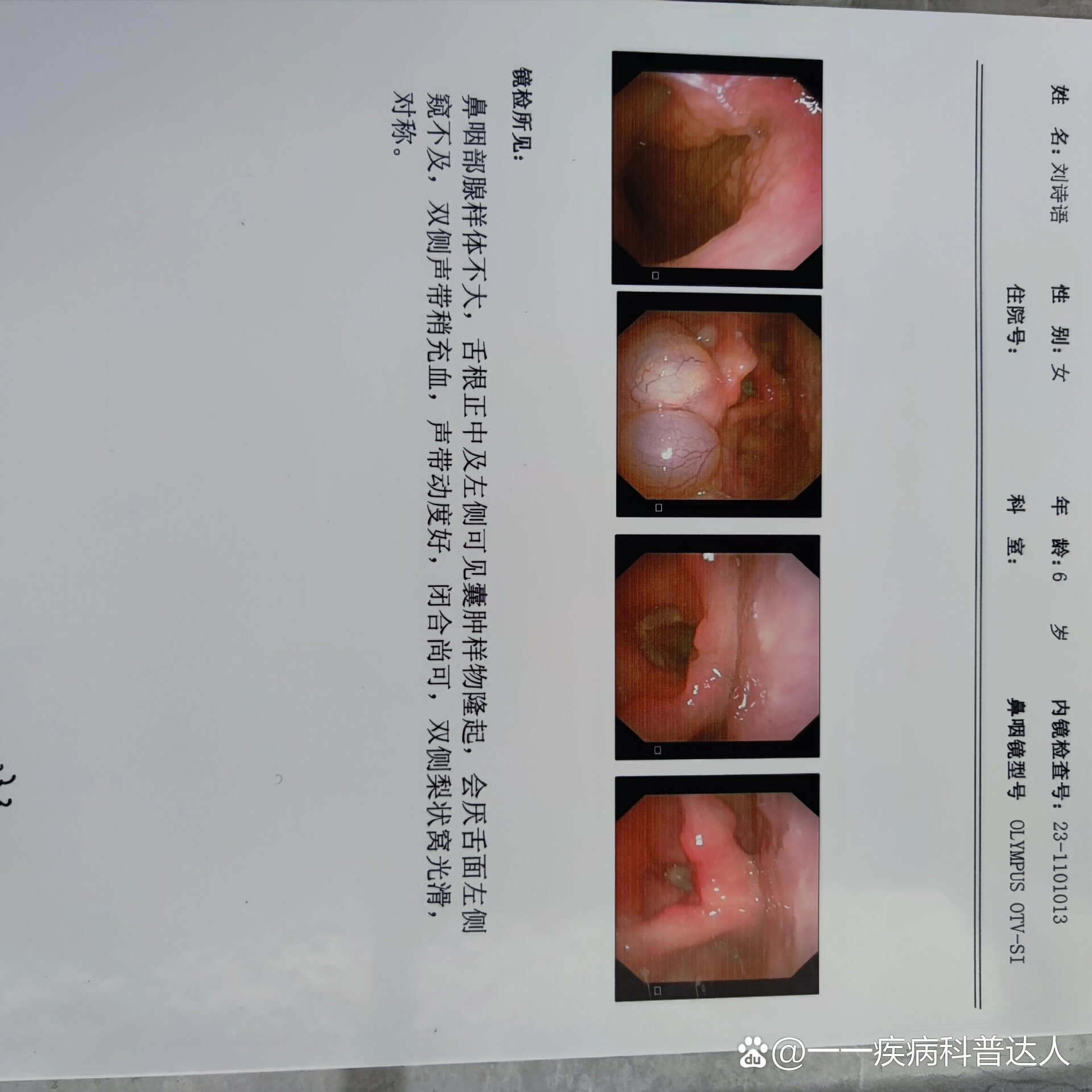 舌骨囊肿刀口图片