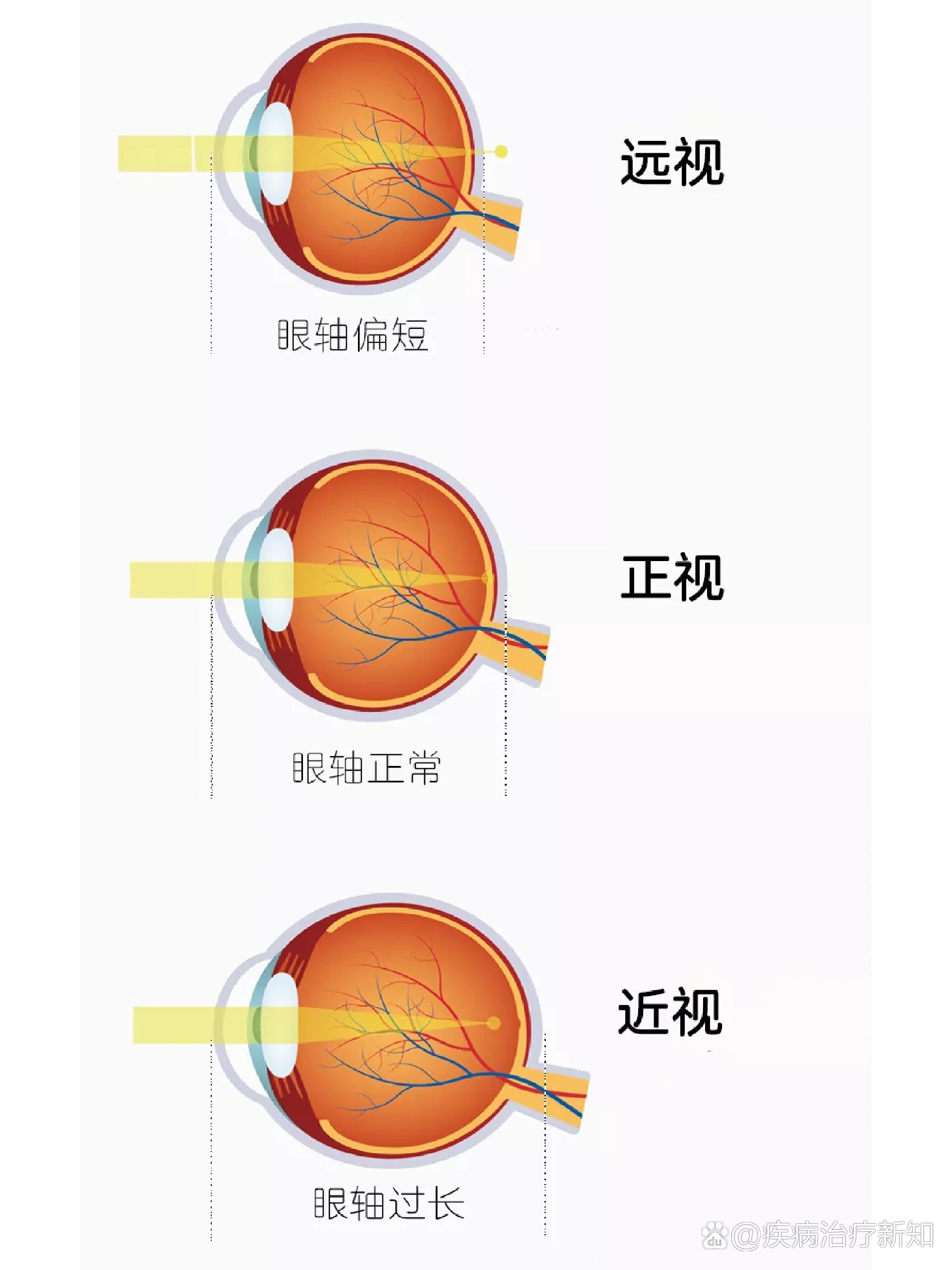 近视眼与正常眼图片