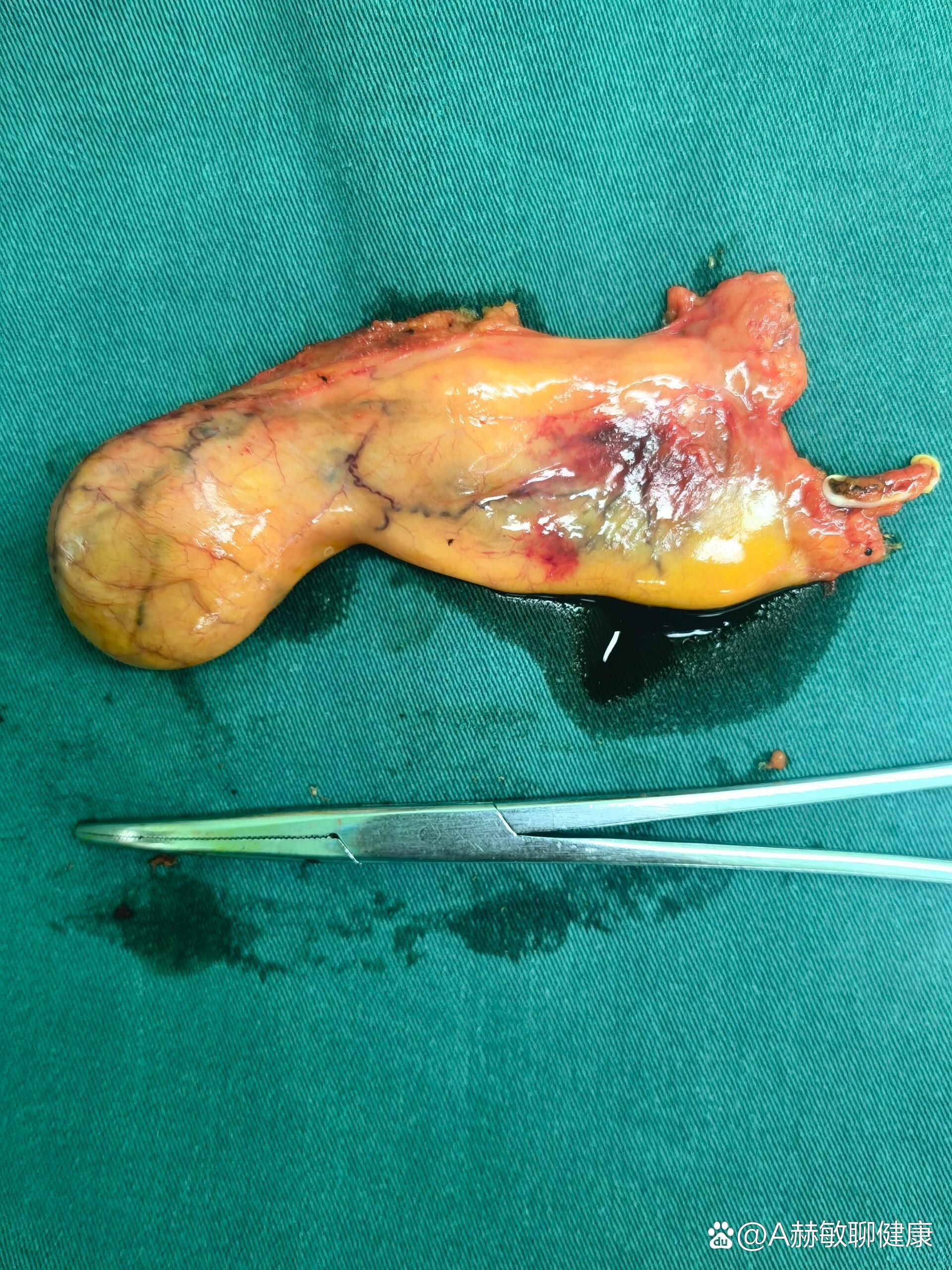 腹腔镜下胆囊切除术