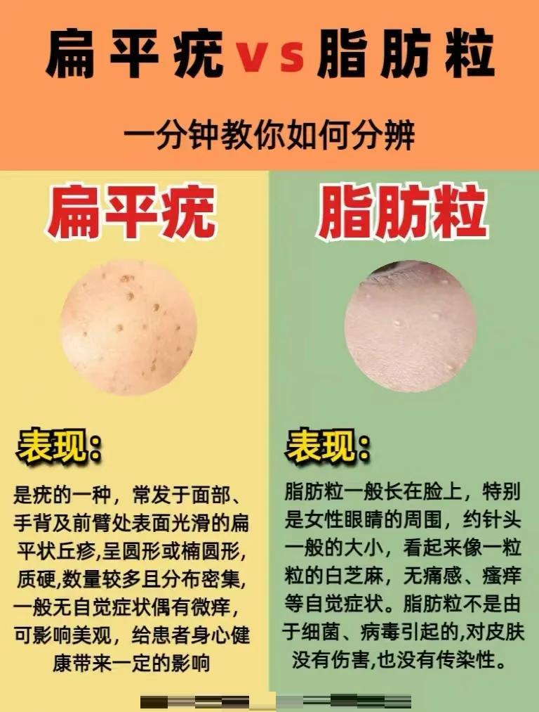 扁平疣与脂肪粒的区别+自救指南
