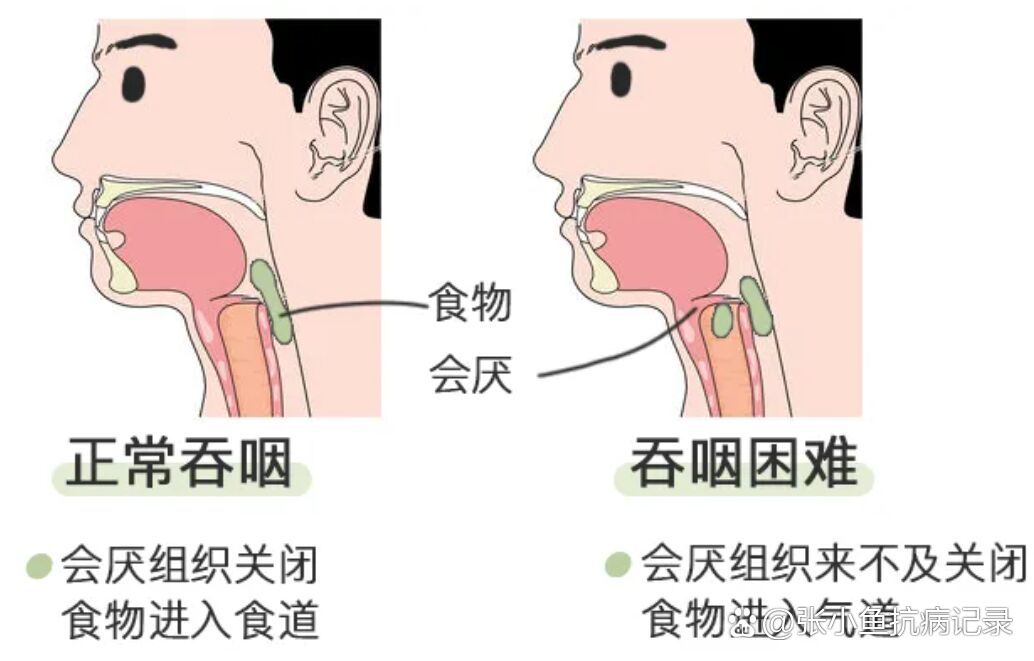 吞咽难,喝水呛,吞咽功能障碍要尽早治疗
