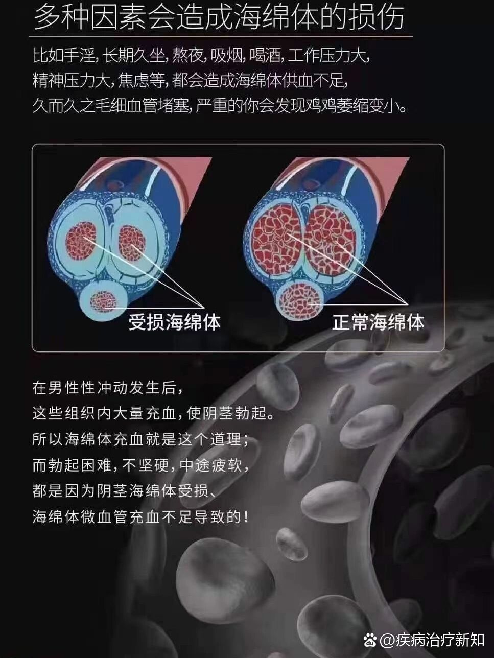 海绵体受损介绍