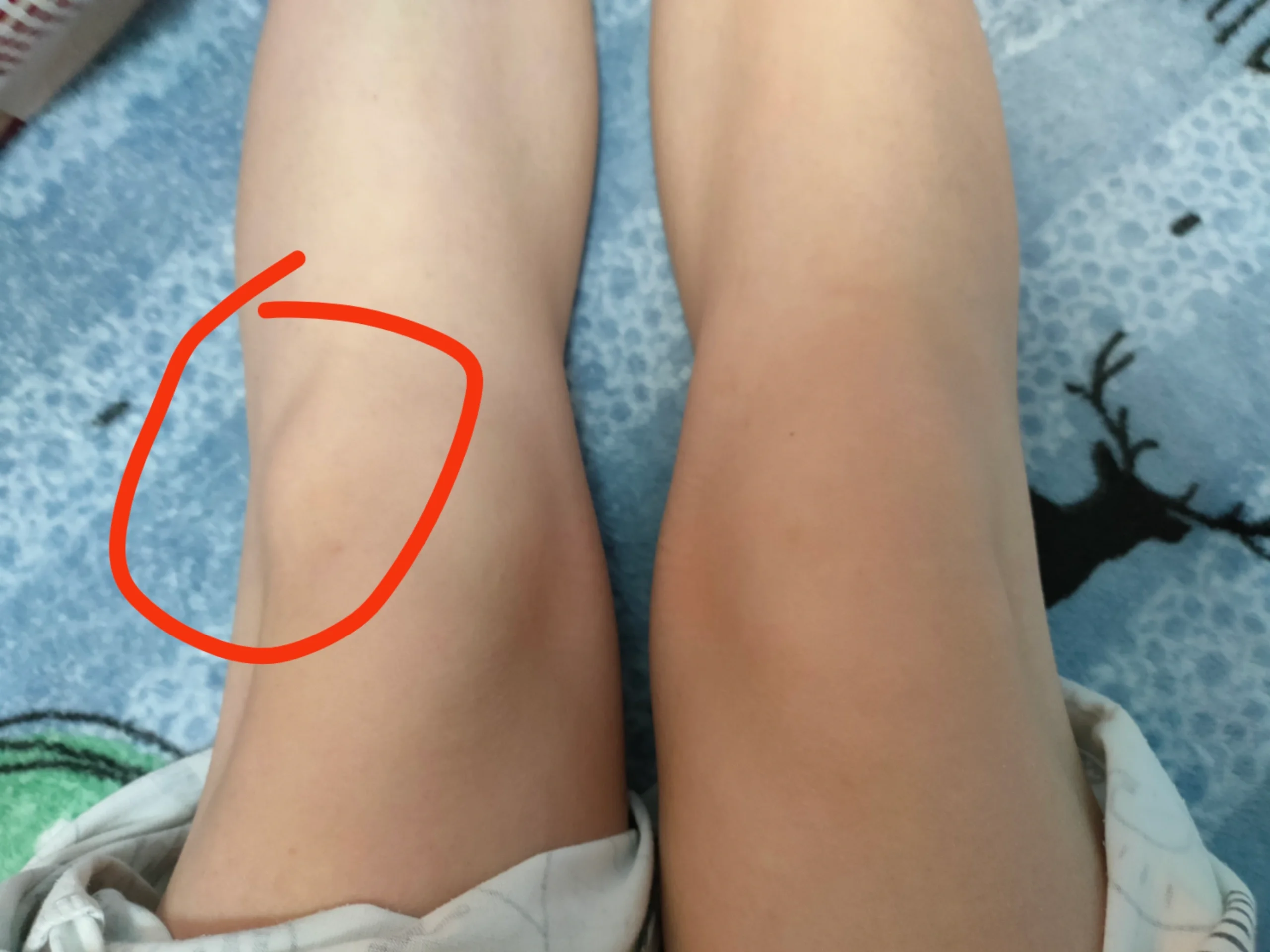 膝盖鼓包,里面长了个囊肿