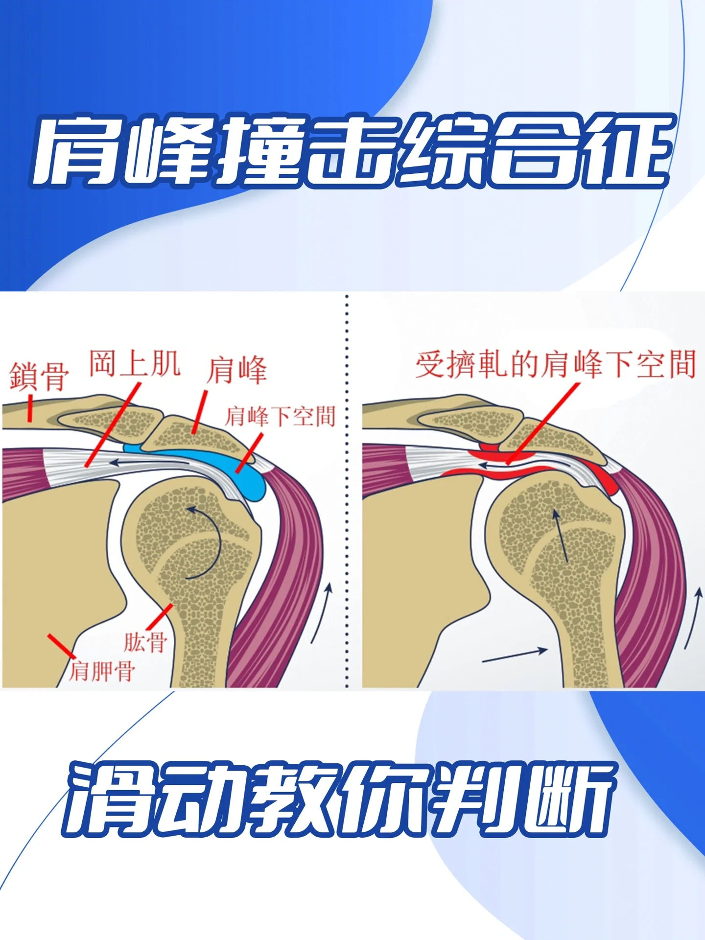 肩峰在哪里个部位图图片