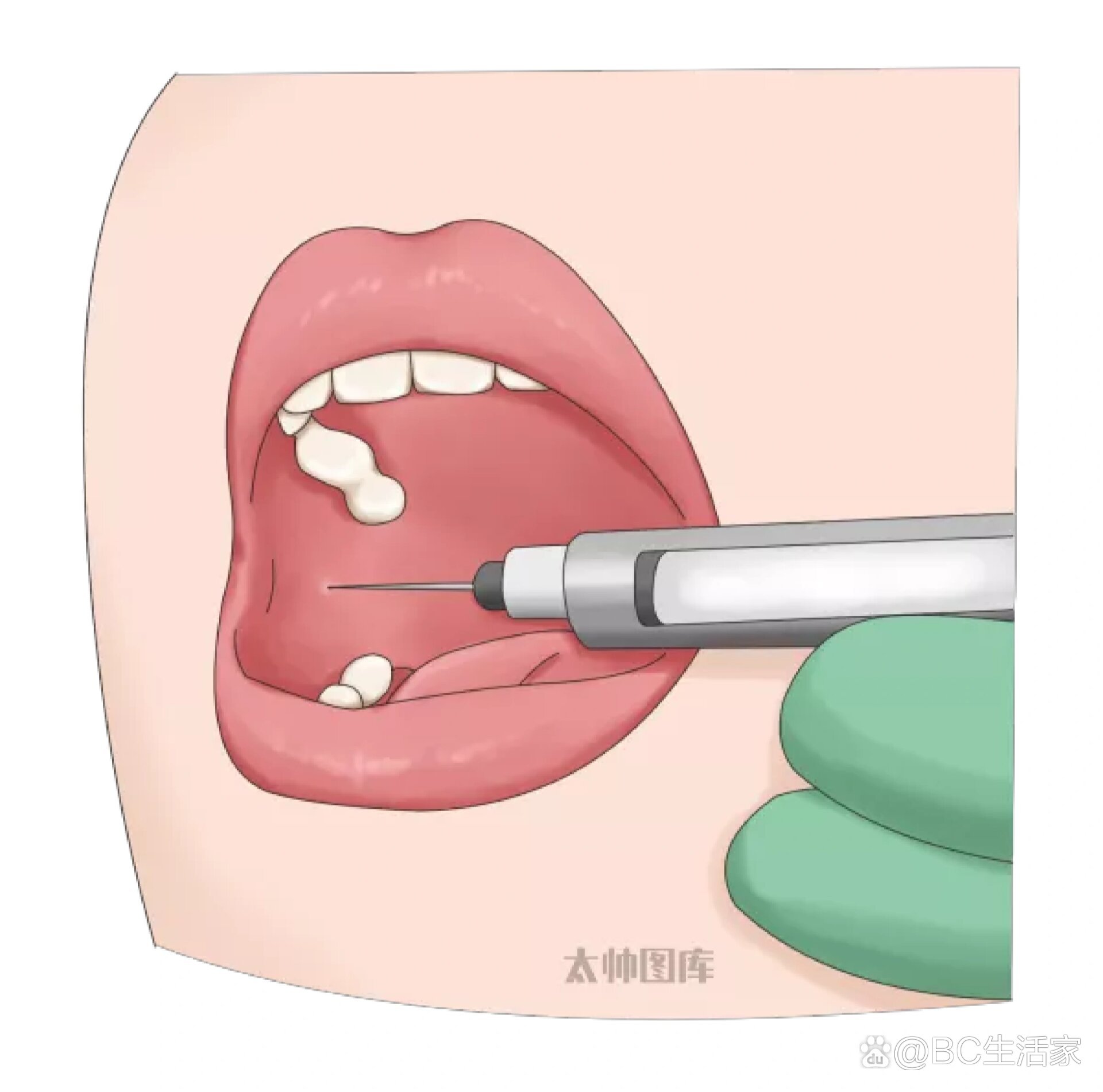  br>口腔拔牙打麻药属于局部麻醉,麻醉的神经都是从脑神经发出来的