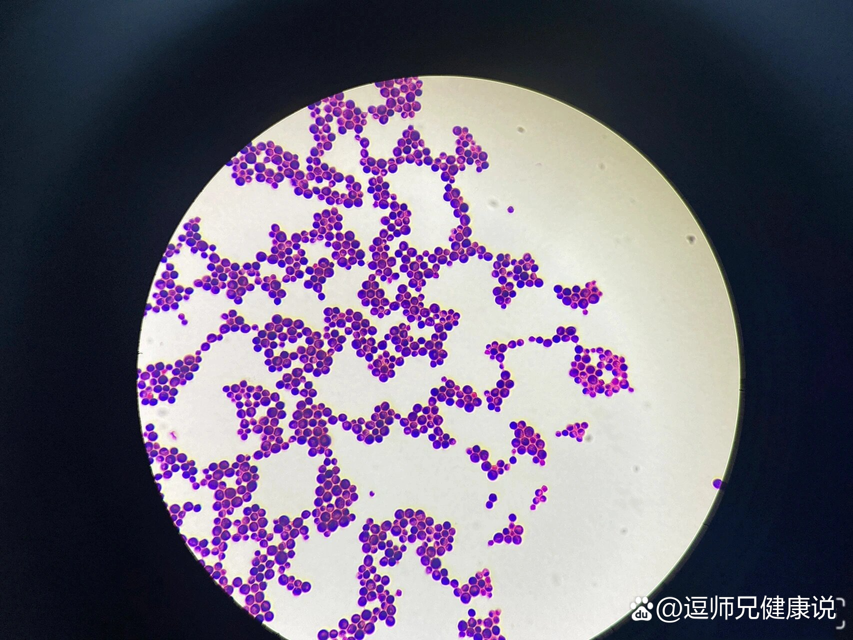 18隐球菌脑膜炎患者csf一般细菌培养涂片及真菌涂片镜下观:圆形或卵