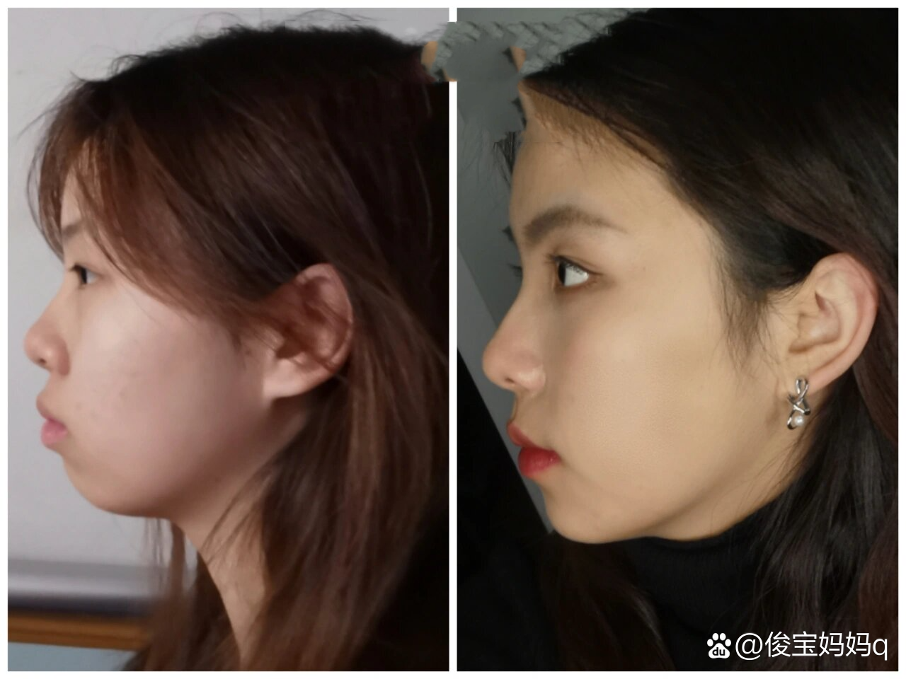 戴牙套一年半侧脸变化