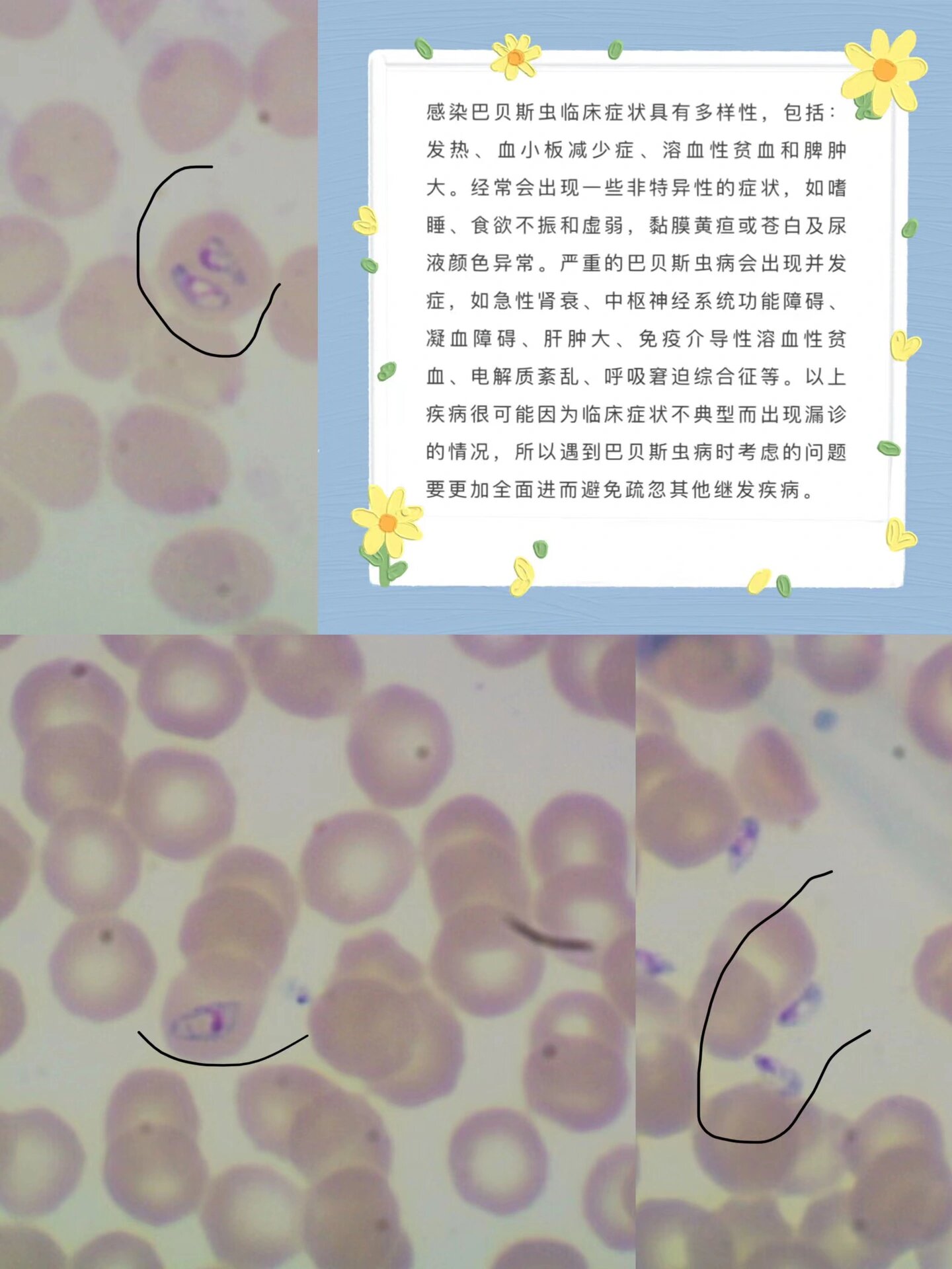 巴贝斯原虫病是指巴贝斯原虫属寄生虫寄生于红细胞内而引起的疾病,该