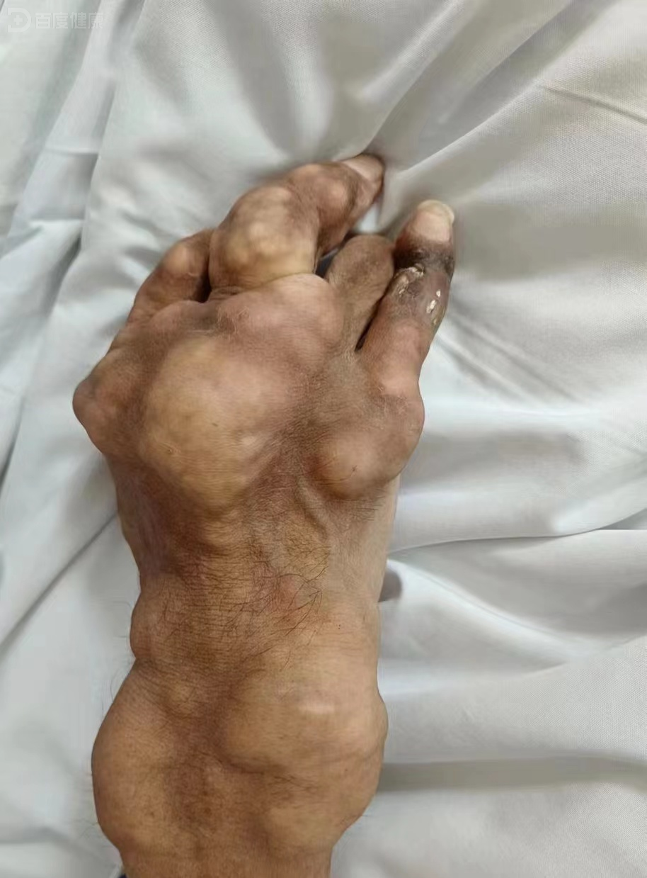 可怕,痛风30年,臀部及胸锁关节都是痛风石