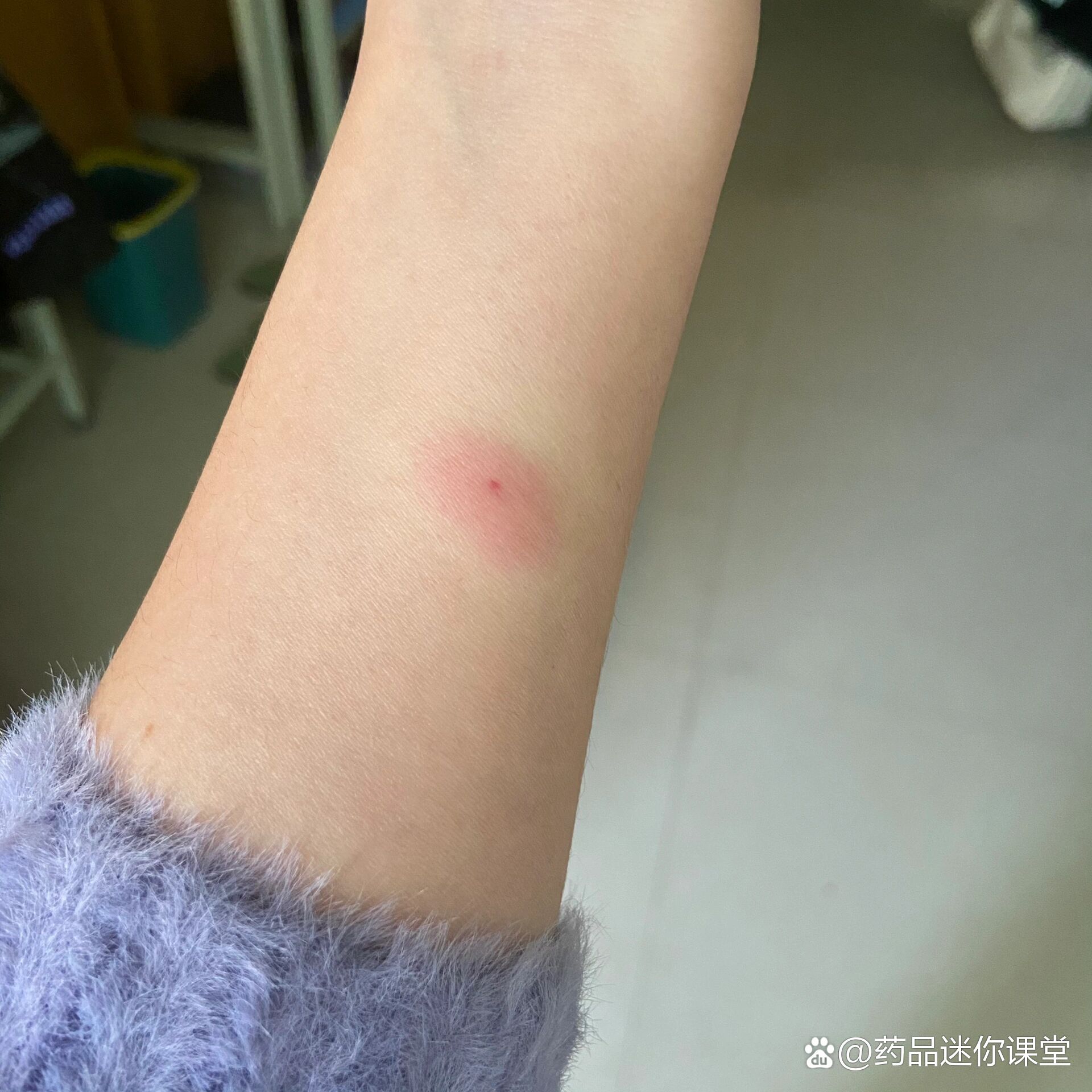  p>结核菌素试验 br>相当于皮试 br>三天前打了一针 br>慢慢出现像被