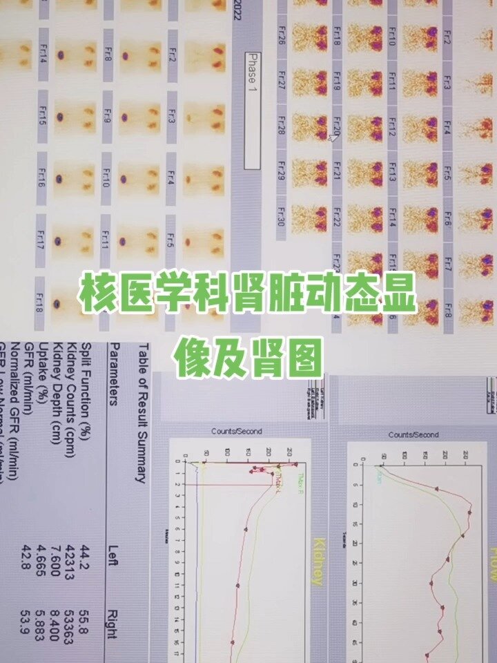 了解核医学科肾脏动态显像及肾图