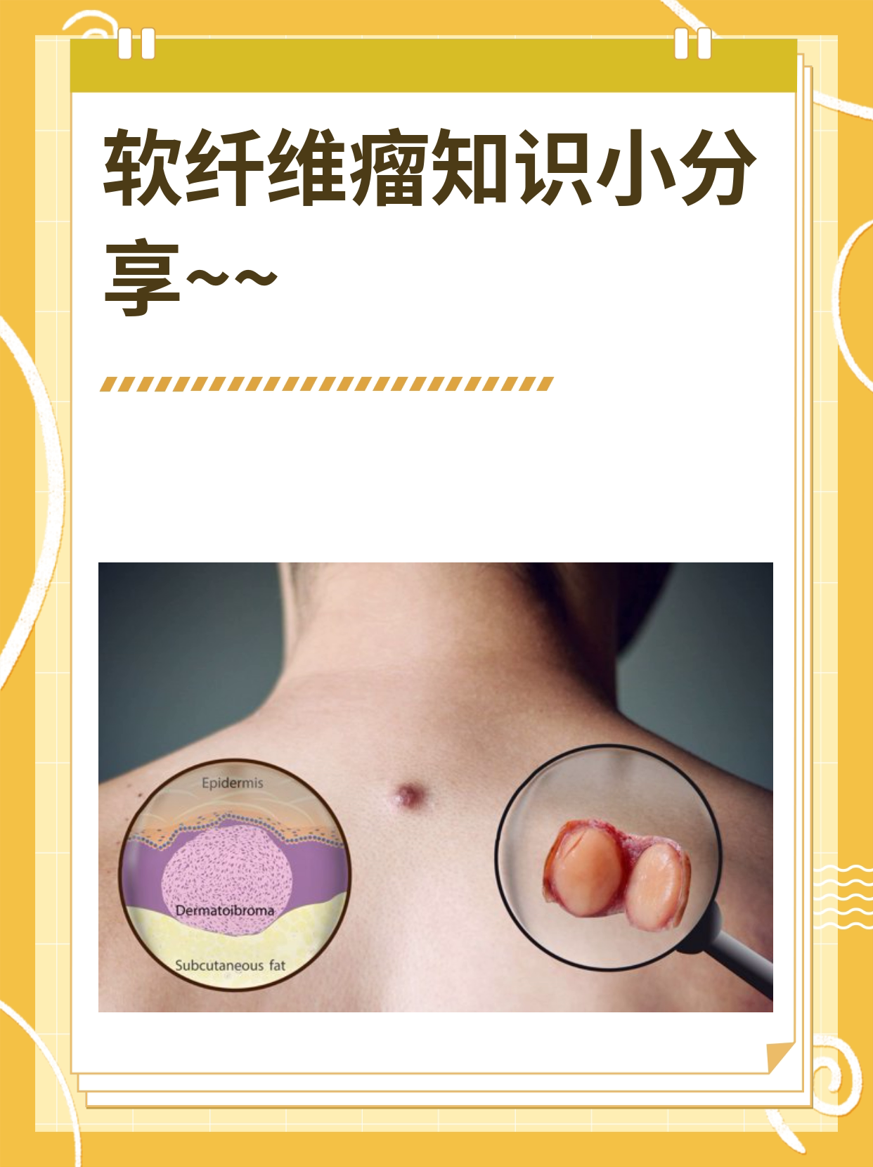 软纤维瘤知识小分享
