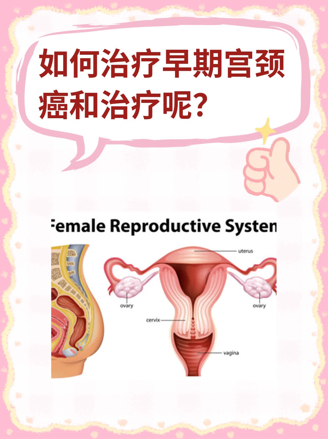 如何治疗早期宫颈癌和治疗呢